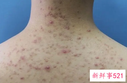 胸口和背部长痘痘怎么回事