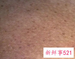 黑色素自己慢慢的会淡化