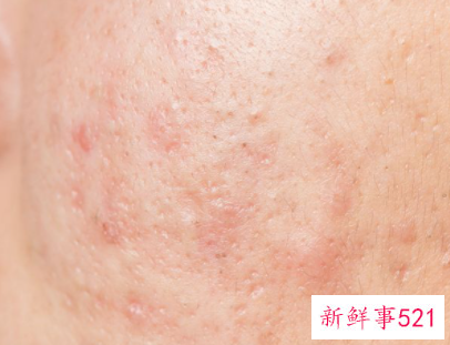 皮肤角质层特别薄怎么办