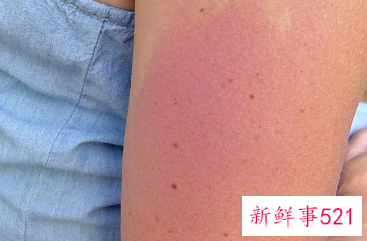 蚊子咬的包硬结像老茧