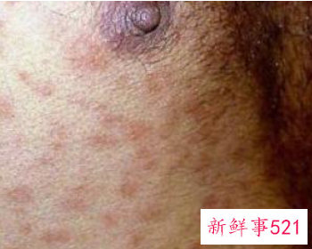 艾滋病初期症状皮疹