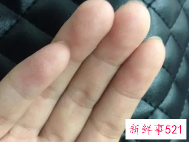 手指肉里有白点按着疼还有脓