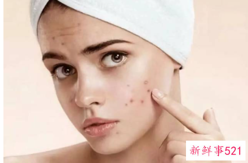 怎么加速黑色痘印淡化