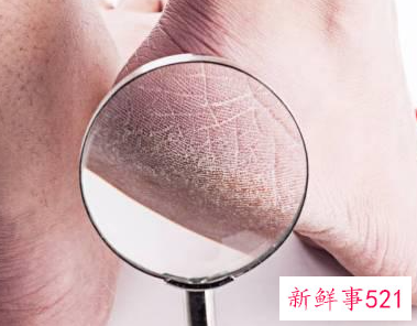 肝不好的人手脚会有5种表现