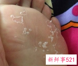 脚上有死皮是什么原因导致的