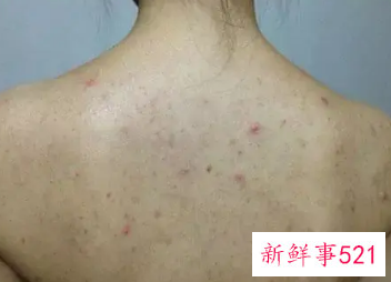 身体皮肤出油严重怎么办