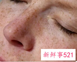 黄褐斑是什么原因引起的可以去掉吗