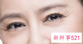 去眼角纹最好的办法