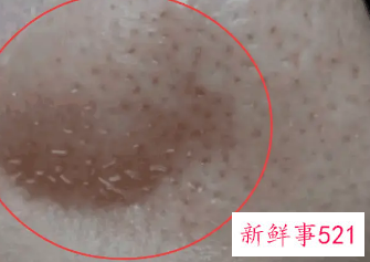 身体皮肤出油严重怎么办