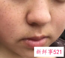 脸颊两边斑点越来越多怎么办