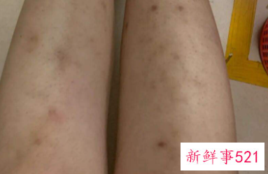 腿冻伤了留下黑印怎么去除