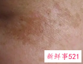 皮肤出现斑点是什么原因
