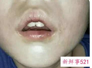 腺样体面容多大年龄定型