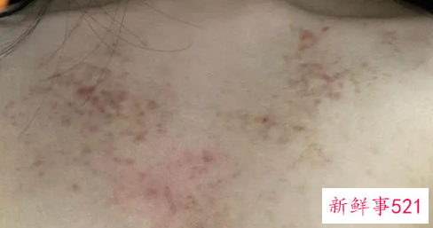 胸口和背部长痘痘怎么回事