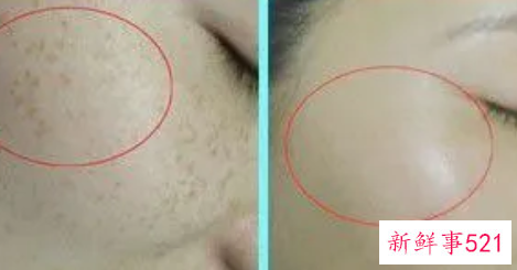 科学祛斑不反弹