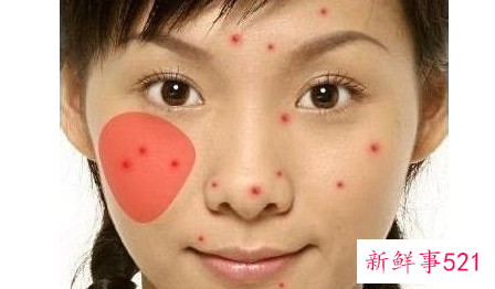 脸上长痘对应五脏示意图