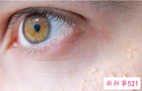 脂肪粒多久会自动脱落