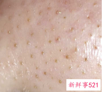 脸上毛孔堵塞怎么清理的