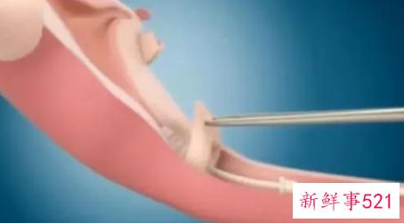 上环对女性有影响没有