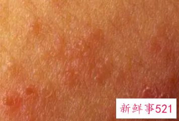 锻炼对皮肤病有好处吗