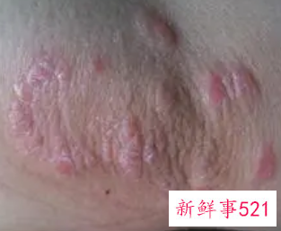 锻炼对皮肤病有好处吗