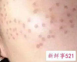 激光祛斑的危害与效果图片