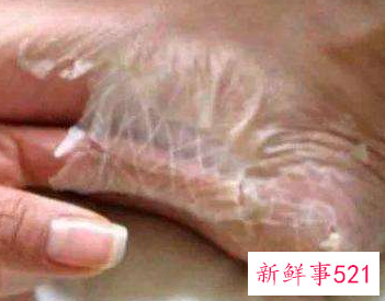 脚上有死皮是什么原因导致的