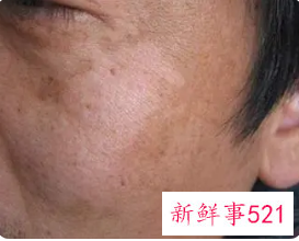 黄褐斑是什么原因引起的可以去掉吗