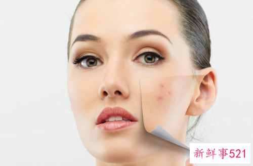 怎么加速黑色痘印淡化