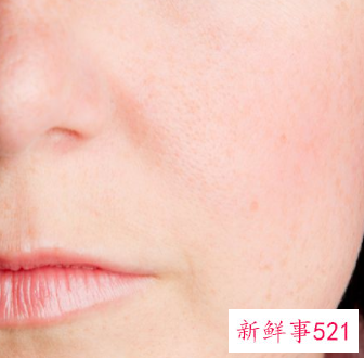 如何解决脸上的痘痘