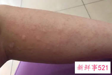 蚊子咬的包硬结像老茧