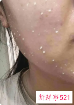 去角质可以改善毛孔粗大吗