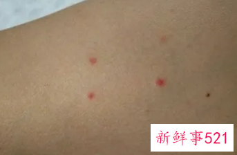 蚊子咬的包硬结像老茧