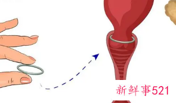 刚取环第一个月容易怀孕吗