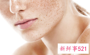 脸颊两边斑点越来越多怎么办
