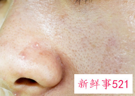 脸上长痘怎么办怎么调理