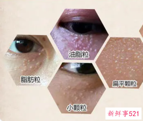 怎样治脂肪粒最有效