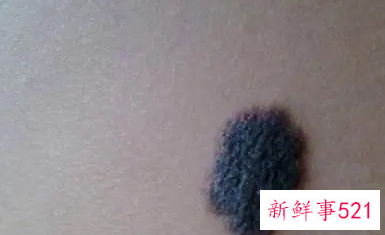 黑痣自己脱落