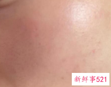 激光祛斑的危害与效果图片