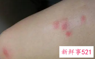 皮肤起红疙瘩什么原因