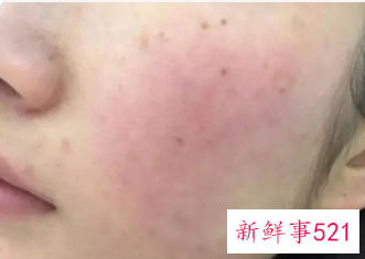 脸上祛痘最好的方法