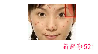 脸上长痘对应五脏示意图