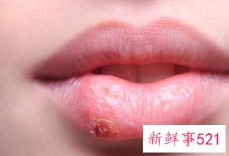 嘴角老脱皮擦什么好