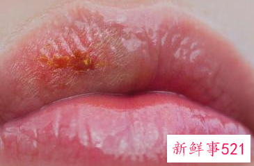 嘴角老脱皮擦什么好