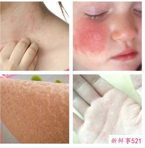 宝宝皮肤干燥要怎么做