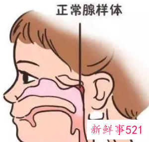 腺样体面容多大年龄定型