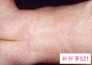 幼儿急疹的好处与坏处