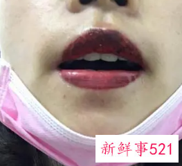 纹唇三年后很丑图片