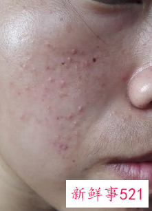 如何解决脸上的痘痘