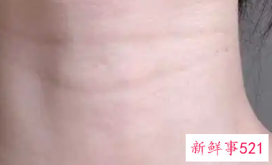 颈纹怎么消除效果好